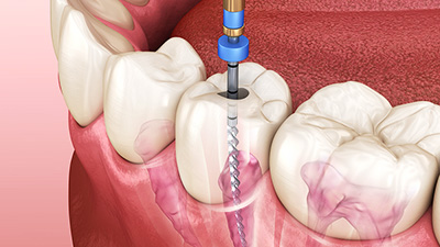 endodonti tedavi, endodonti nedir?, endodonti fiyatları,