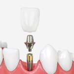 implant diş tedavi, implant diş tedavi nedir?, implant diş tedavi fiyatları,